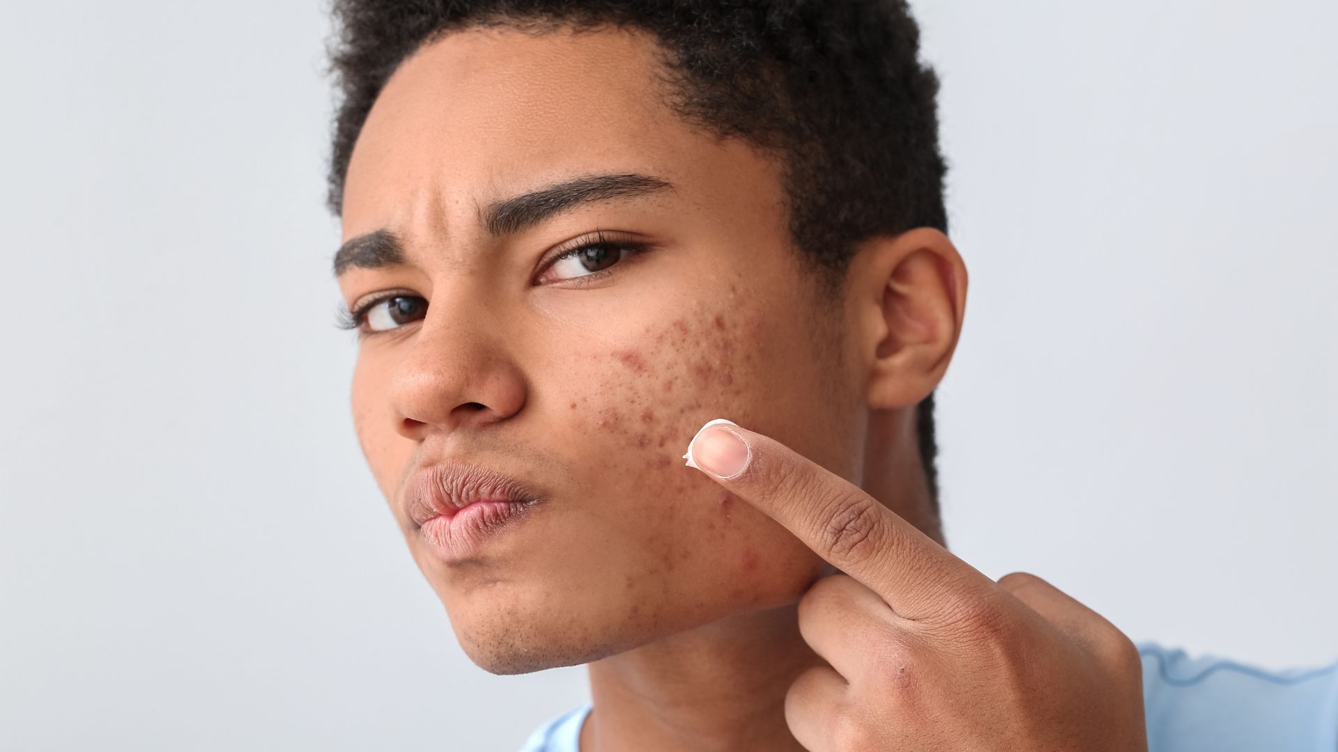 The Top 5 Natural Ingredients for Fighting Blemishes and Acne